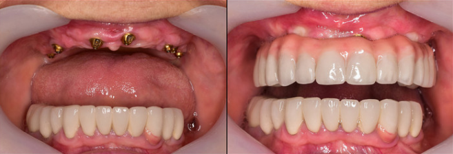 Implantes de carga inmediata