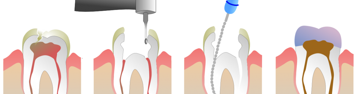 Endodoncia en Córdoba