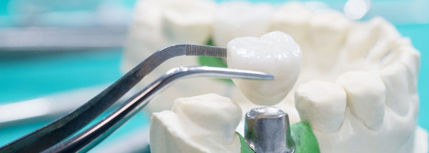 Ventajas de elegir implantes dentales - Clínica Manuel Rosa