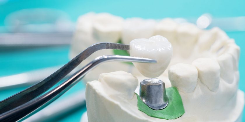 Ventajas de elegir implantes dentales - Clínica Manuel Rosa