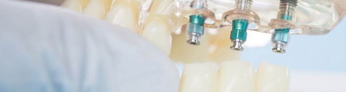 Implantes dentales en Córdoba