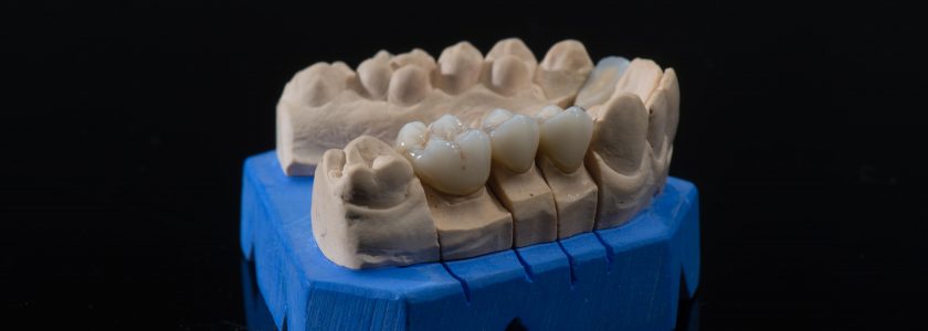 Estética dental en Córdoba: carillas y fundas dentales. ¿Cómo diferenciarlas? - Clínica Manuel Rosa