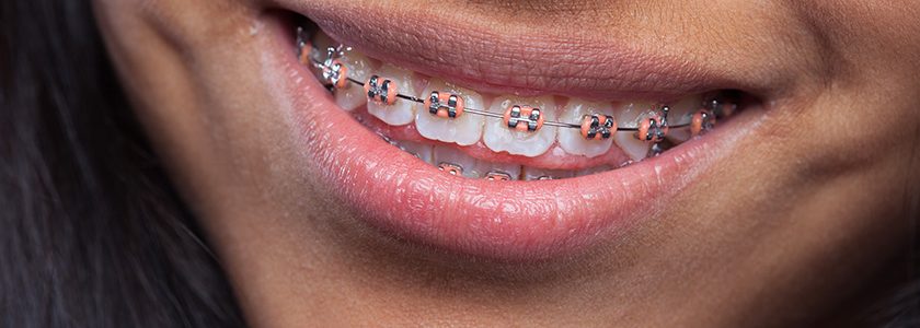 Ortodoncia para adultos ¿Cuál es la ortodoncia más recomendada para mí? - Clínica Manuel Rosa