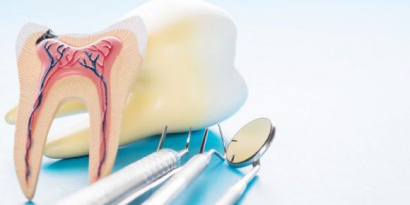¿Por qué necesito una endodoncia? - Clínica Manuel Rosa