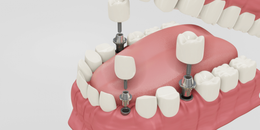 ¿Conoces los implantes con cirugía guiada? - Clínica Manuel Rosa