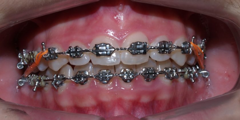 Ortodoncias: tipos y características. - Clínica Manuel Rosa