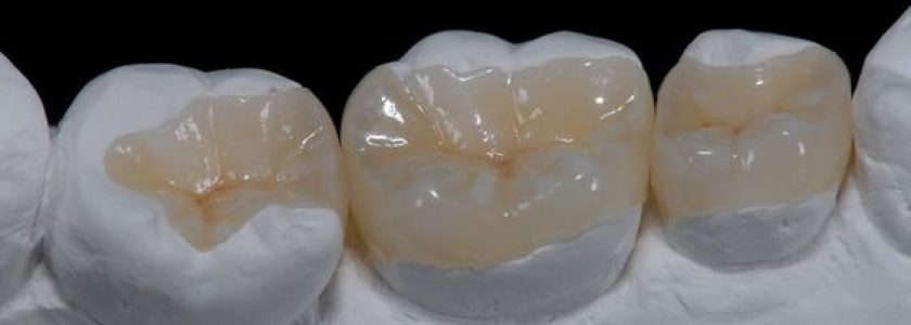 Incrustación, la mejor manera de reconstruir una pieza de endodoncia - Clínica Manuel Rosa
