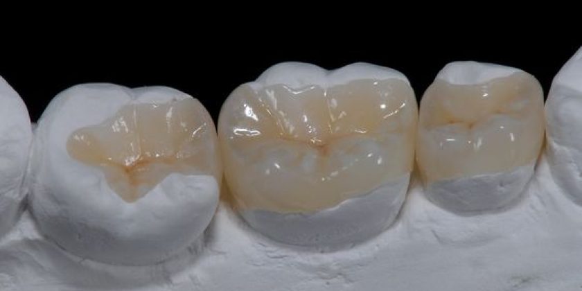 Incrustación, la mejor manera de reconstruir una pieza de endodoncia - Clínica Manuel Rosa