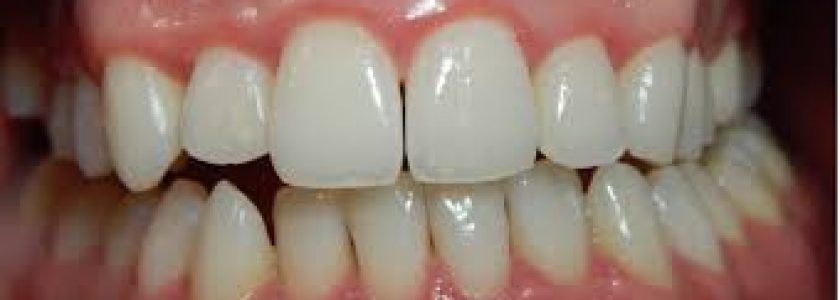 Gingivitis y periodontitis, ¿Qué son y cómo diferenciarlas? - Clínica Manuel Rosa