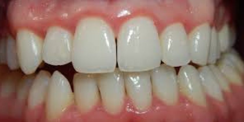 Gingivitis y periodontitis, ¿Qué son y cómo diferenciarlas? - Clínica Manuel Rosa